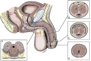 Диаметры уретры и спонгиозного тела на различных уровнях